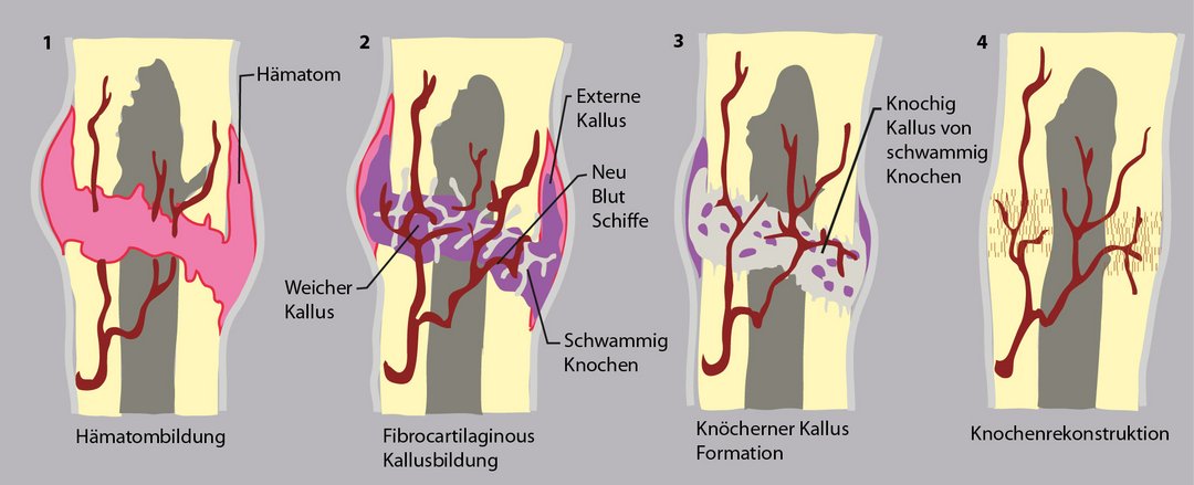 Abbildung eines Knochenheilungsprozess